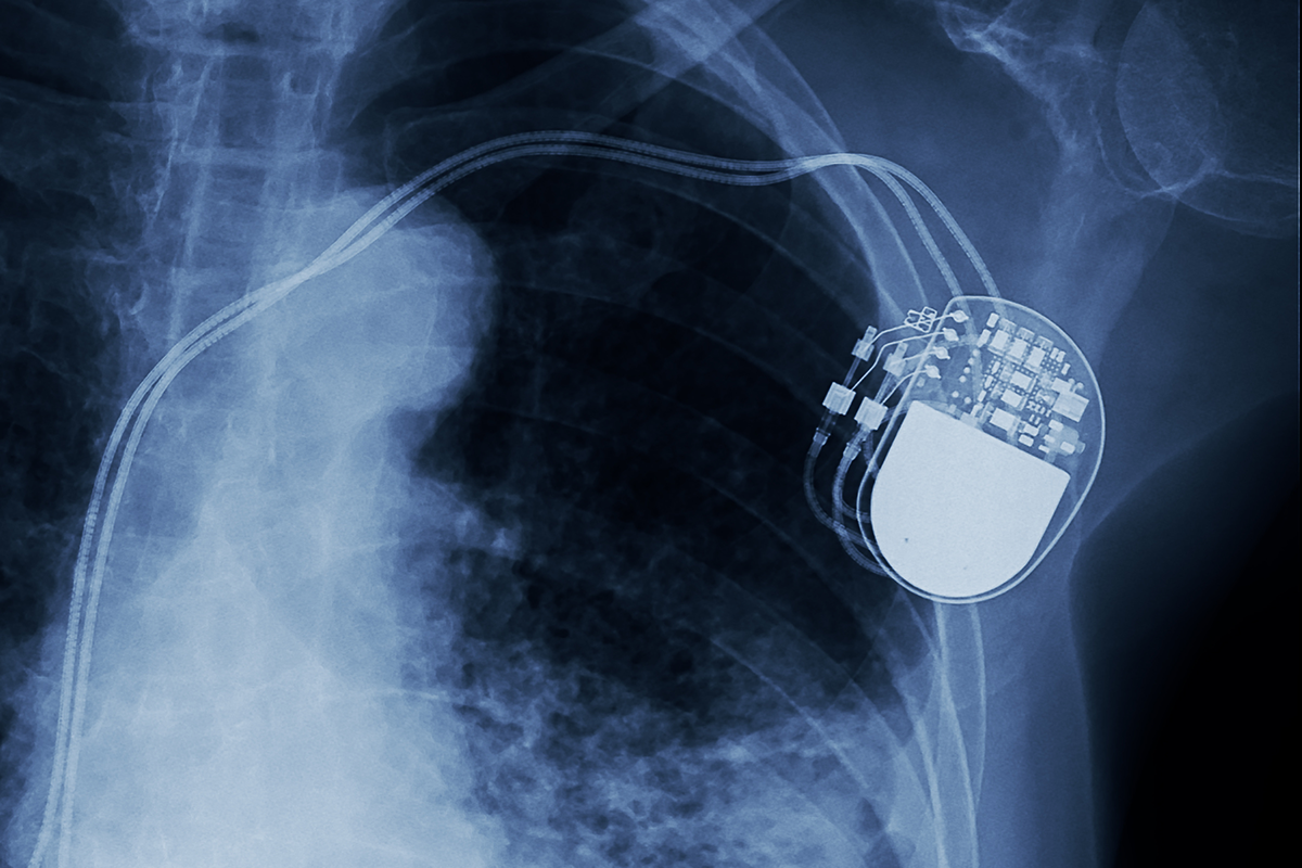 Pacemakers Recalled Over Hacking Concerns
